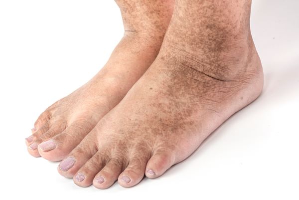 Diabetic Foot Care