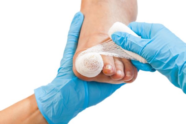 Ingrown Toenail Surgery